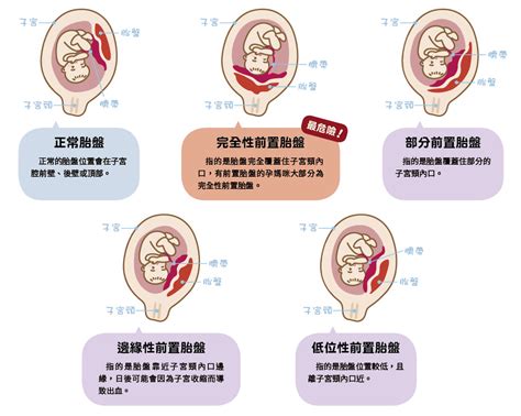 隱藏性胎盤剝離|認識胎盤早期剝離！醫師分享胎盤剝離症狀及預防方法｜親子天